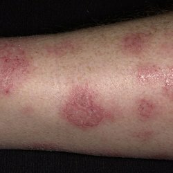 Symptomer på atopisk dermatitt