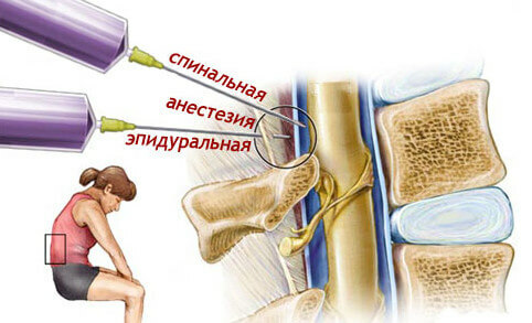 spinale-epidurale-e1425561671411