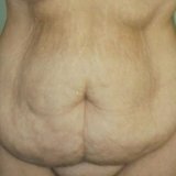 Cirurgia de parede abdominal
