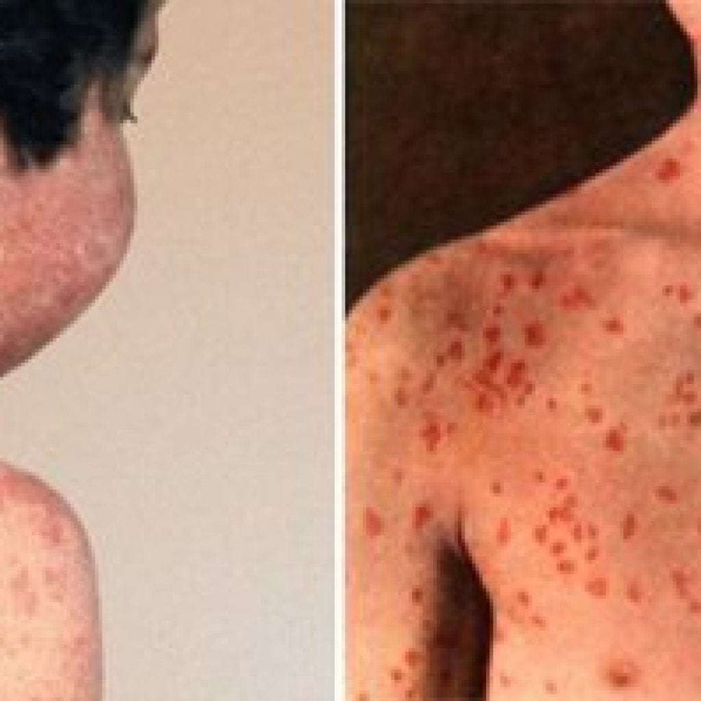 Measles: symptoms in children, photos, description of the disease