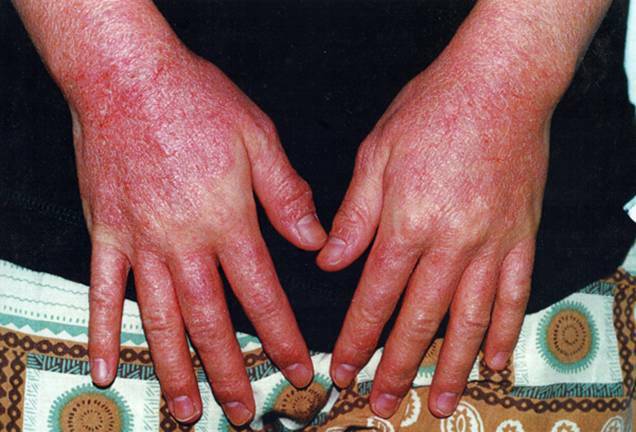 Allergiás dermatitis: tünetek és kezelés