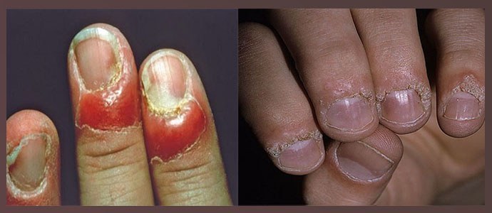Nagelhaut- und Hautverbrennungen, Narben