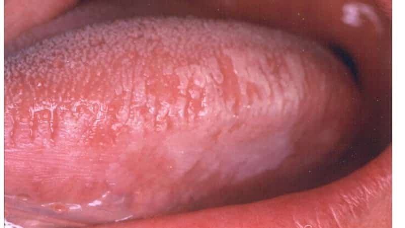 leucoplachia della fotografia cavità orale