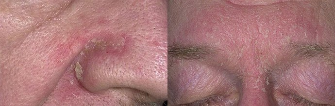 Seborrheás dermatitisz az arcon: kezelés, fotó, krém, diéta