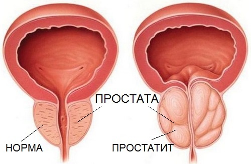 Why does prostatitis occur in young men?