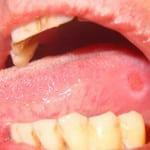 úlceras na boca