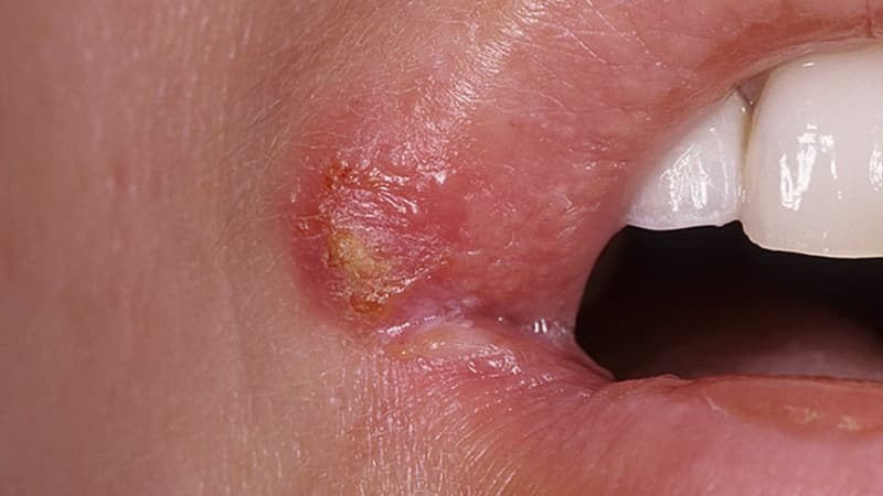 Arten von Herpes auf den Lippen Foto