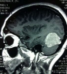 Tumör i hjärnans foto