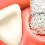 Heilung des Zahnfleischs nach Zahn gezogen