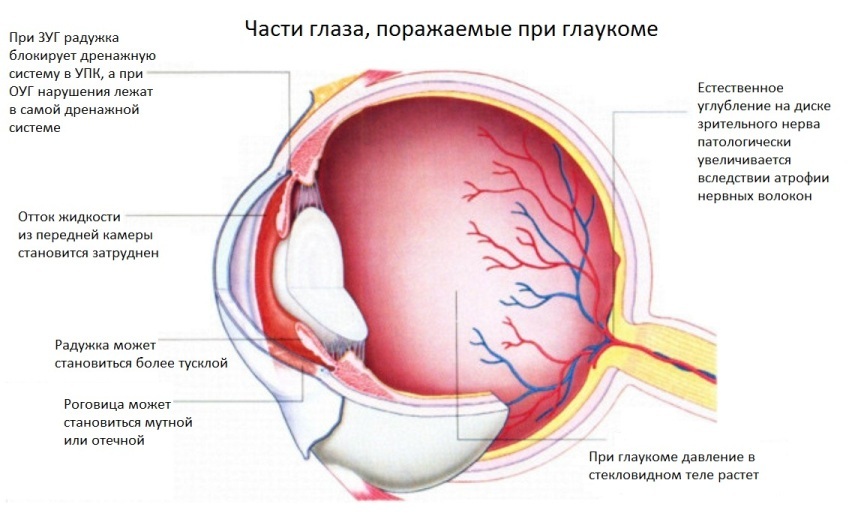 Glaucoma: sintomas, causas, diagnóstico, prevenção e tratamento