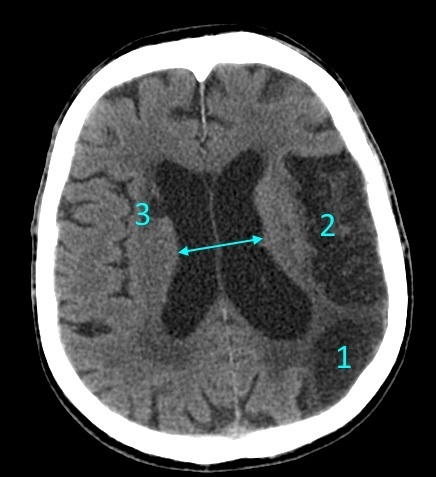 Scanner( CT) van het hoofd