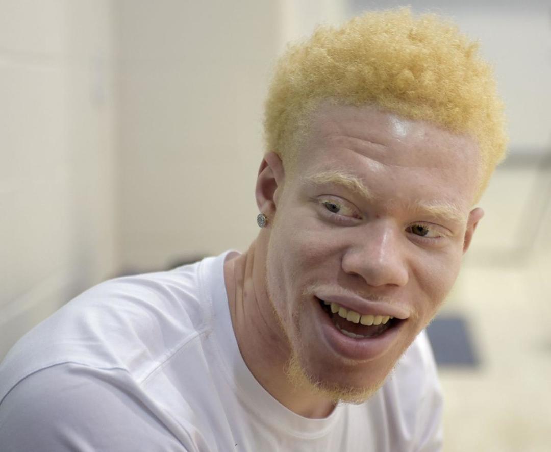 Albinizmus emberekben: mi ez, tünetek, kezelés, okok
