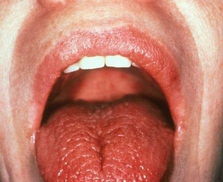 Pourquoi piquent la langue démange causes de traitement qui font