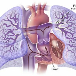 Primäre pulmonale Hypertonie