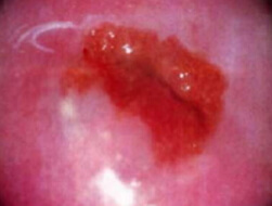 Cervicale ectopia foto