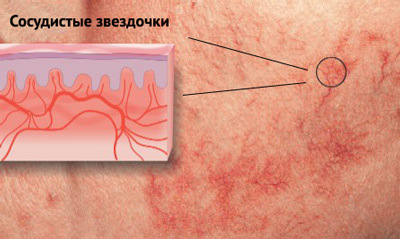 How to remove and remove the spider veins on the face, legs and body?