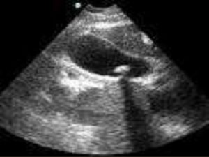 Flegmoneuze cholecystitis