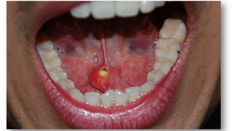 Piedra en la glándula salival: Tratamiento ptyalolithiasis