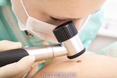 Contraindications to removal of birthmarks by laser