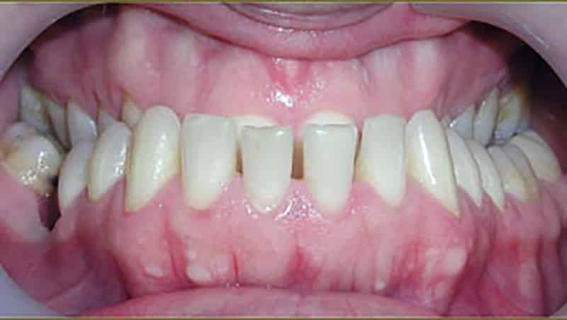 Korrektur der Zähne bei Erwachsenen