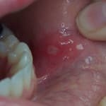 Kako za zdravljenje razjed v ustih