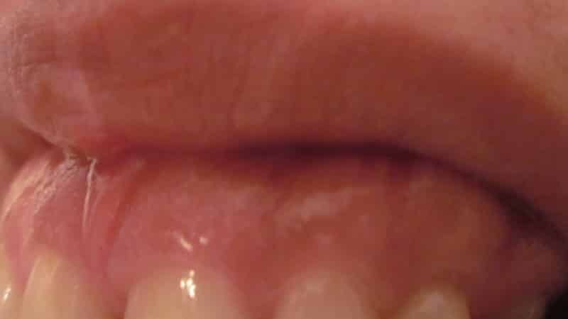 Weiße Flecken Auf Zahnfleisch