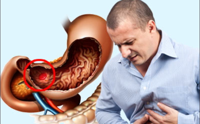 Gastroenteritis - Entzündung des Magen-Darm-Traktes