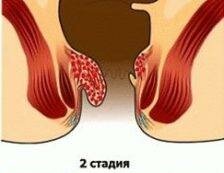 2 etapas
