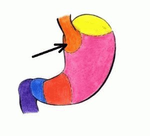 Antrum ulkus: lokacija in značilnosti