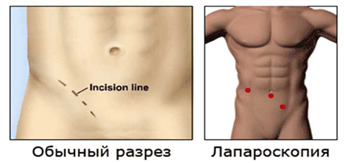 Operacija za inguinalnu kila kod muškaraca - vrste operacija, priprema, prognozu