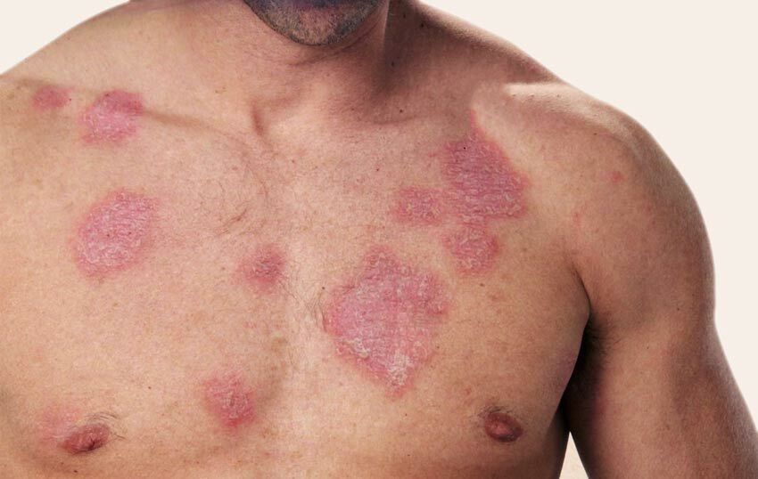 Tuberkulose der Haut - Symptome und Fotos