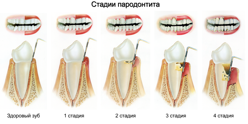 Stage-development-periodontitis