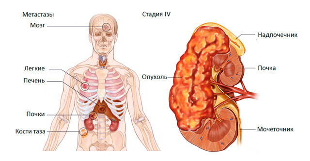 Rak faza 4-Kidney