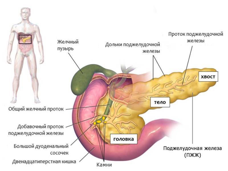 Development of pancreatitis. Stones in the pancreatic ducts