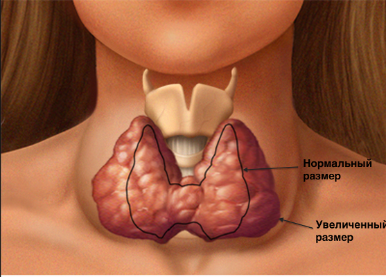 Thyroid enlargement - causes, symptoms, diagnosis