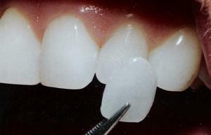 Skallfasetter er installert hvis bare ødelagt en del av tannen.