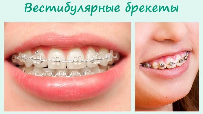 Arten von Klammern an den Zähnen
