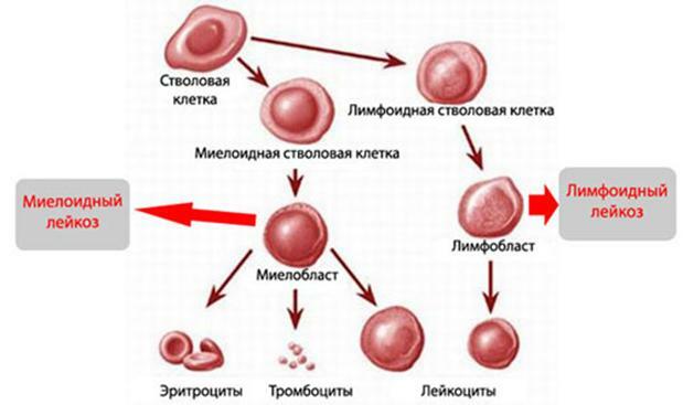Soorten leukemie acute