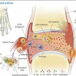 Characteristics of rheumatoid arthritis