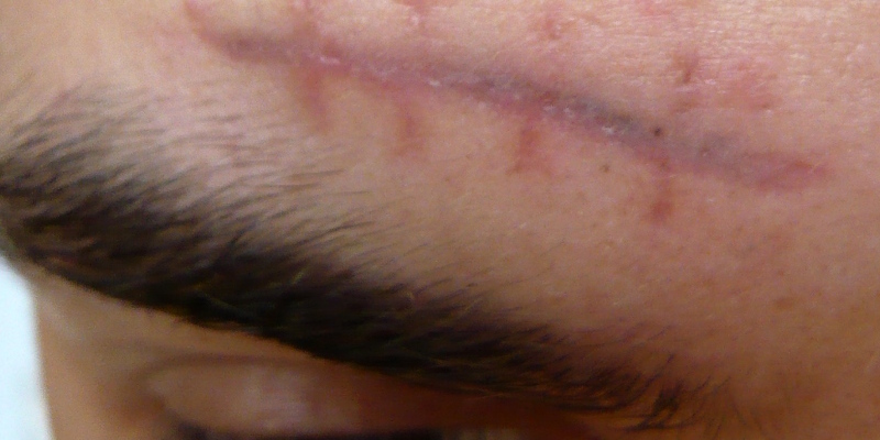 Liječenje ožiljaka na licu