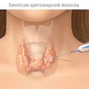 Shchitovidka-y-women
