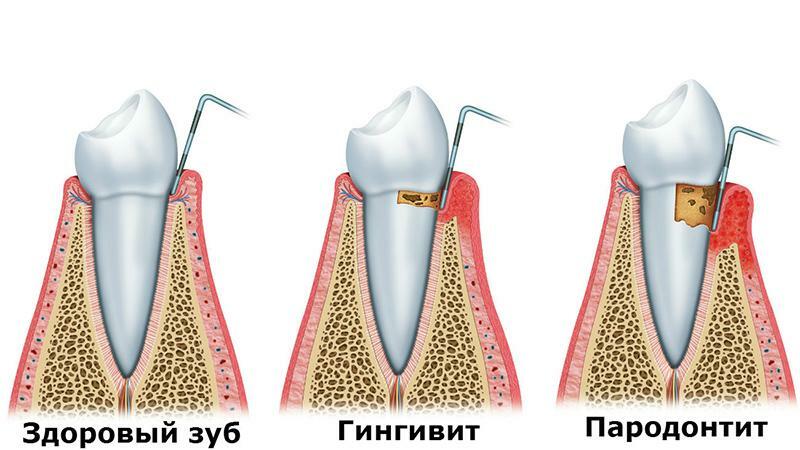 Parodontit och gingivit