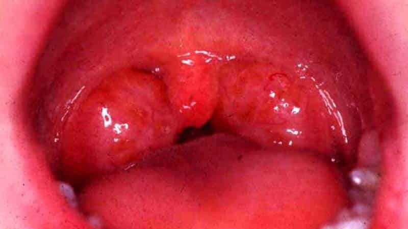 Causes of bleeding from the mouth