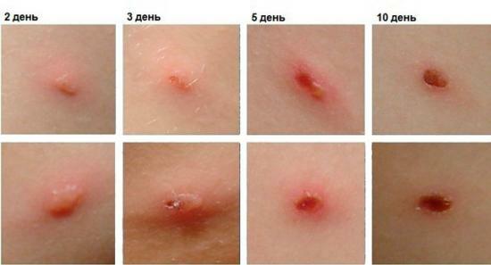 Chickenpox, adult disease, symptoms, course, possible complications