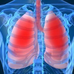 Eosinophilic pneumonia of the lungs