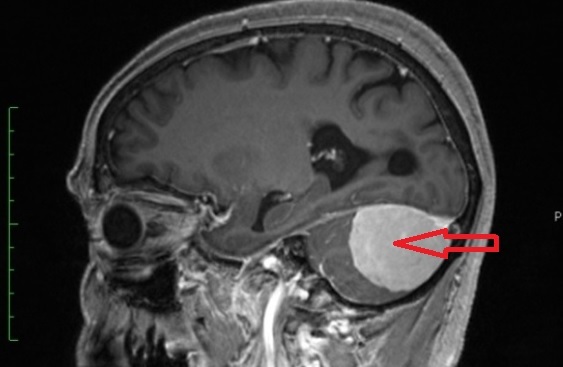 Diagnoza in zdravljenje možganskih tumorjev
