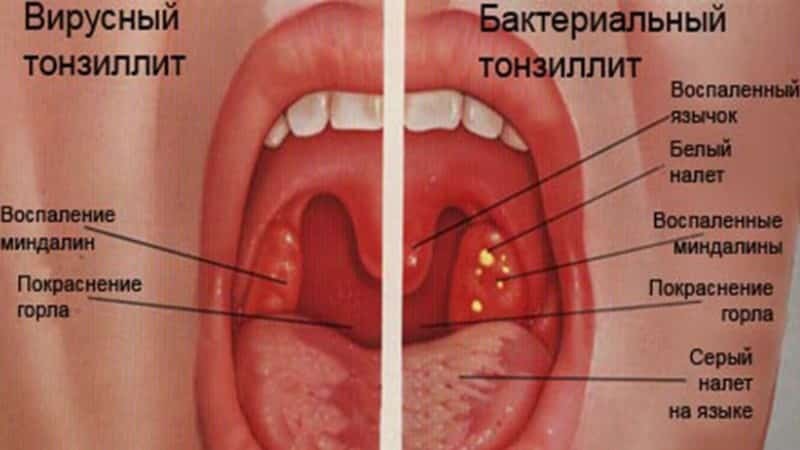 Behandlung von chronischer Tonsillitis