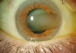 White spots in the eyes