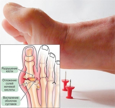 Sintomas da artrite gotosa