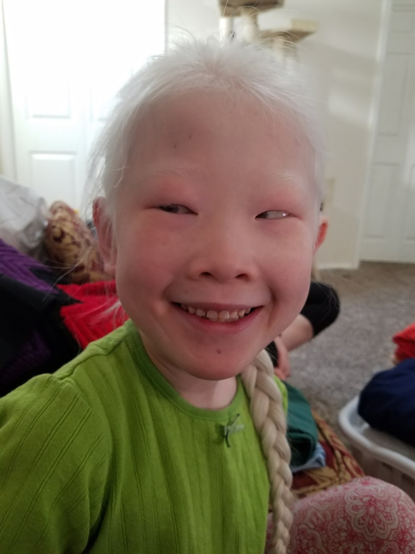 Albinismo oculocutaneo: che cos'è, sintomi, trattamento, prognosi